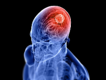 Brain Tumor Classifier project preview